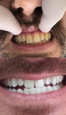 Clareamento dental (Foto: Divulgação) 