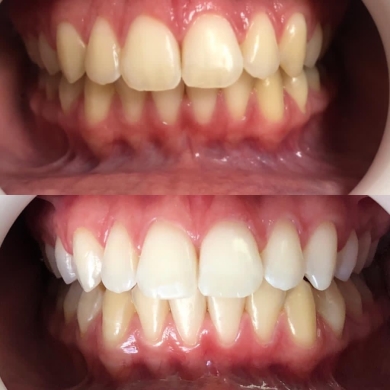 Clareamento dental (Foto: Divulgação) 