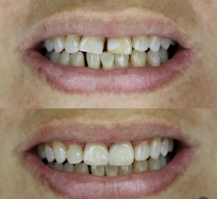Facetas de resina de alta performance, de dois dentes superiores frontais (Foto: Divulgação) 