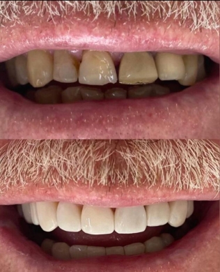 Facetas de resina de alta performance (Foto: Divulgação) 